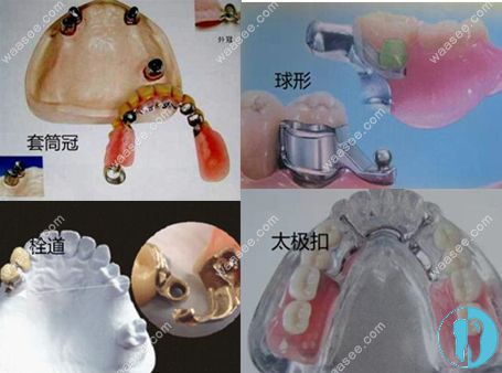 精密附着体可摘局部义齿的种类