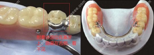 精密附着体可摘局部义齿