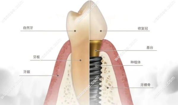 韩国奥齿泰种植牙能使用多久