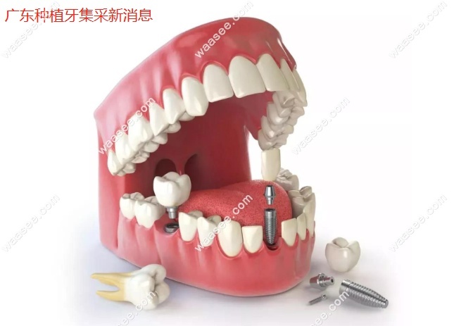 广东种植牙集采新消息www.waasee.com