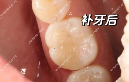 补一颗后槽牙
