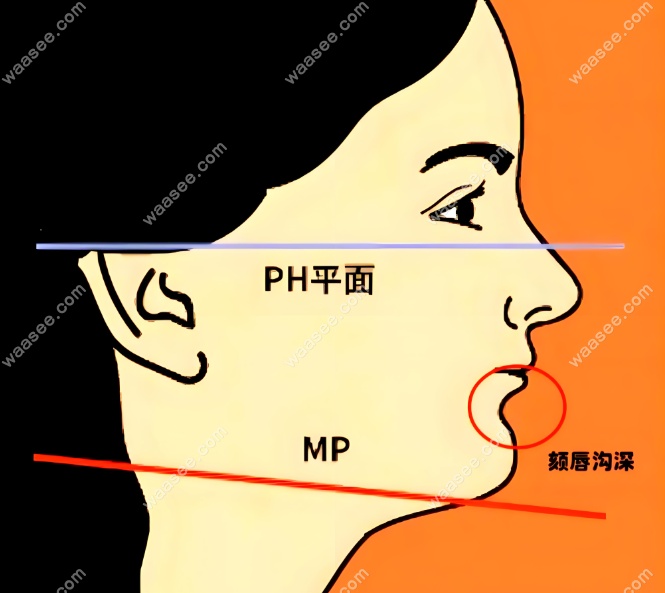 成人牙齿深覆盖怎么矫正