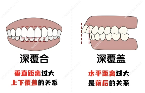 深覆盖和深覆合对比