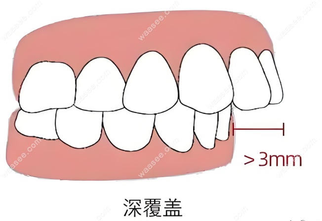 牙齿深覆盖