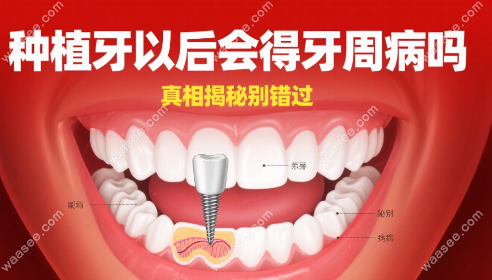 种植牙以后会得牙周病吗
