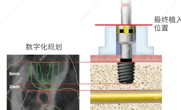 4-8.5mm多规格的韩国奥齿泰种植体