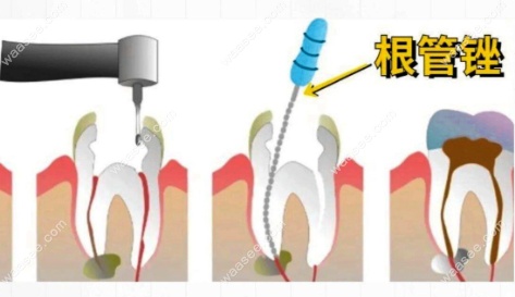 根管治疗