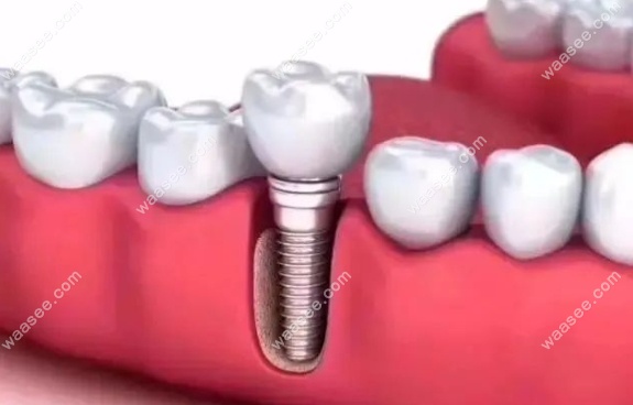 口腔种植