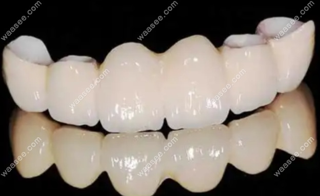 杜塞拉姆(doceram)全瓷牙如何辨别真伪