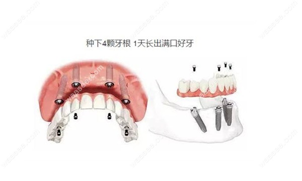 青岛莱恩口腔种植牙凭啥便宜