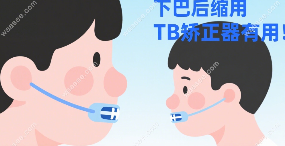 下巴后缩用tb矫正器有用!300人实测:有效几率60%,但这3类别用