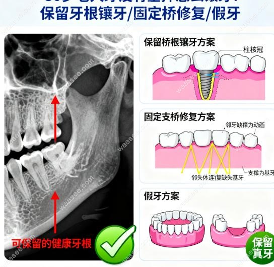 80岁老人牙没有全掉怎么镶牙?保留牙根镶牙/固定桥修复/假牙