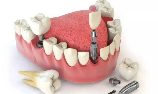 诺贝尔PMC种植体