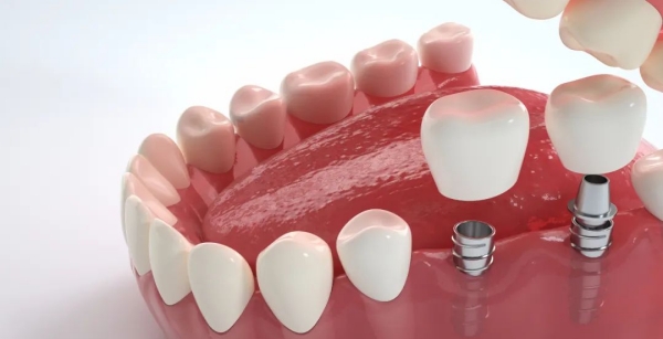 诺贝尔PMC种植体