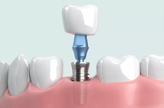 选择诺贝尔PMC种植体有哪些常见误区