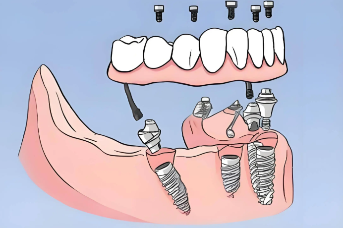 深圳全口种植费用构成及影响因素
