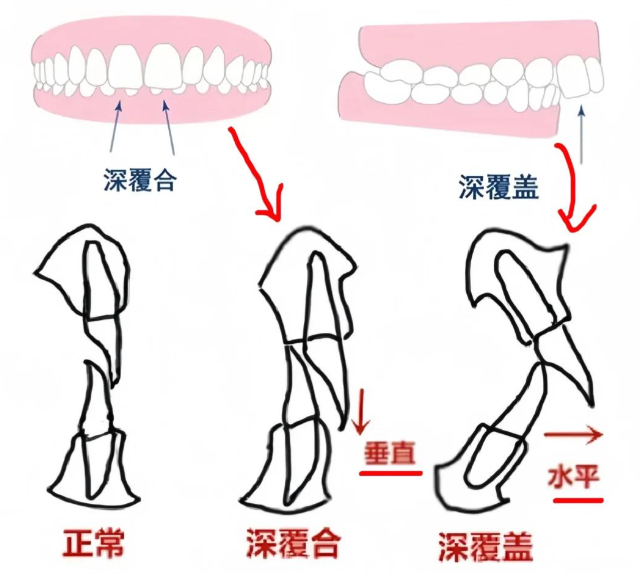 北京深覆合矫正哪家医院好？新排名出炉，这10家公立私立口碑爆棚